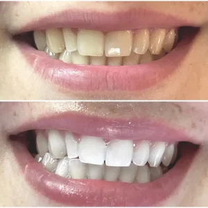 blanchiment dentaire l'aigle