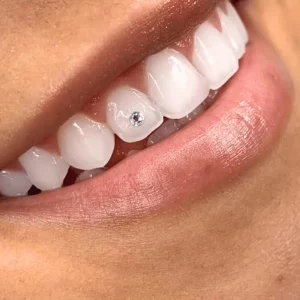 Strass dentaire l'Aigle